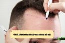 Cấy tóc giá bao nhiêu tiền? Cập nhật bảng giá mới nhất