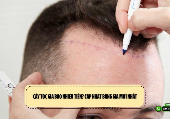 Cấy tóc giá bao nhiêu tiền? Cập nhật bảng giá mới nhất