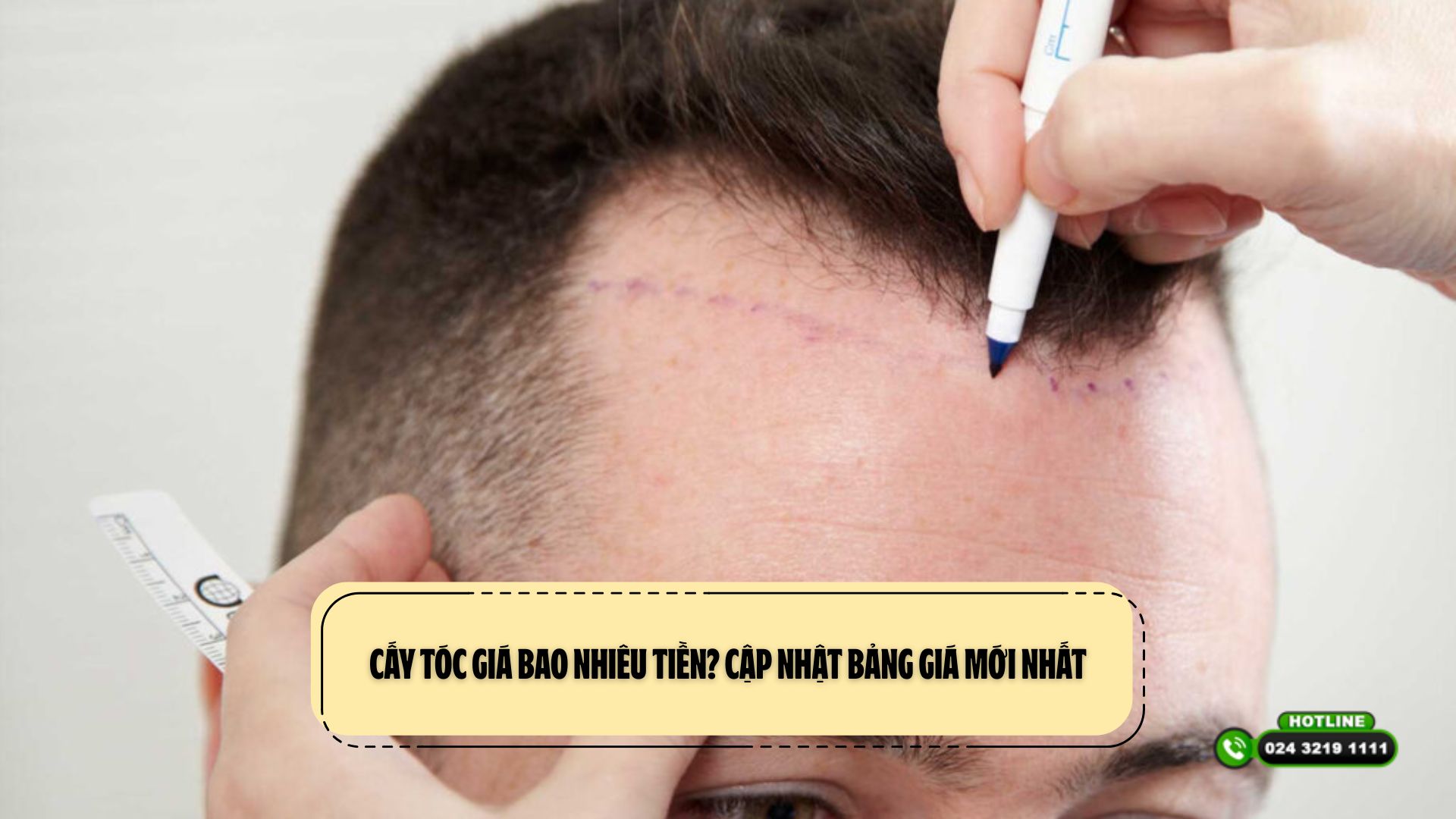 Cấy tóc giá bao nhiêu tiền? Cập nhật bảng giá mới nhất