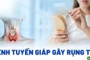 Bệnh tuyến giáp gây rụng tóc làm sao để khắc phục?