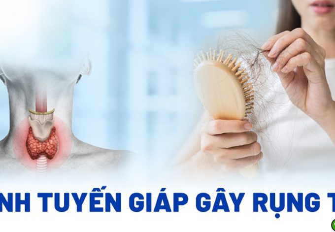 Bệnh tuyến giáp gây rụng tóc làm sao để khắc phục?