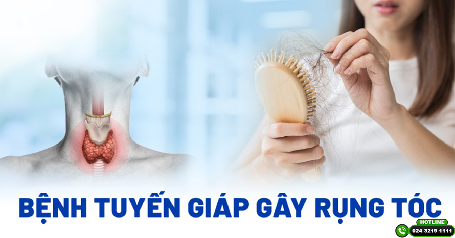 Bệnh tuyến giáp gây rụng tóc làm sao để khắc phục?