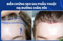 Biến chứng sẹo sau phẫu thuật hạ đường chân tóc – Điều bạn nên biết trước khi thực hiện