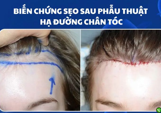 Biến chứng sẹo sau phẫu thuật hạ đường chân tóc – Điều bạn nên biết trước khi thực hiện