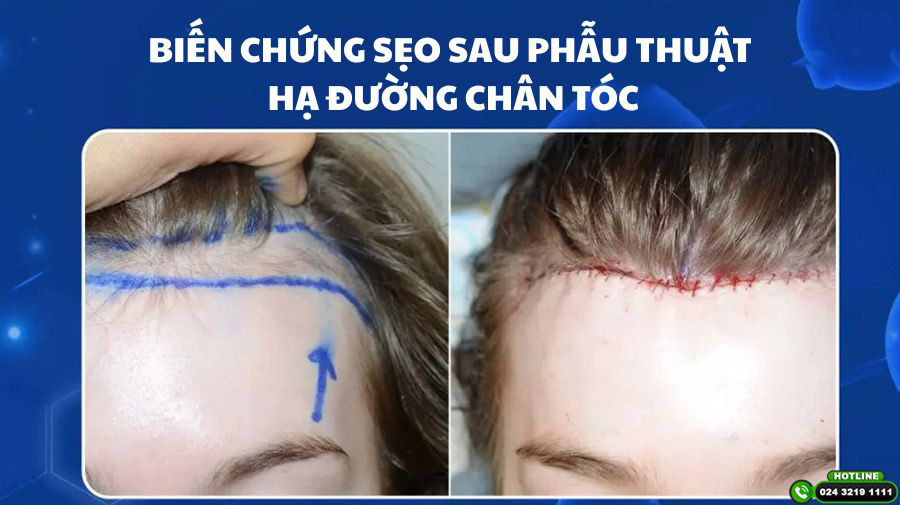 Biến chứng sẹo sau phẫu thuật hạ đường chân tóc – Điều bạn nên biết trước khi thực hiện
