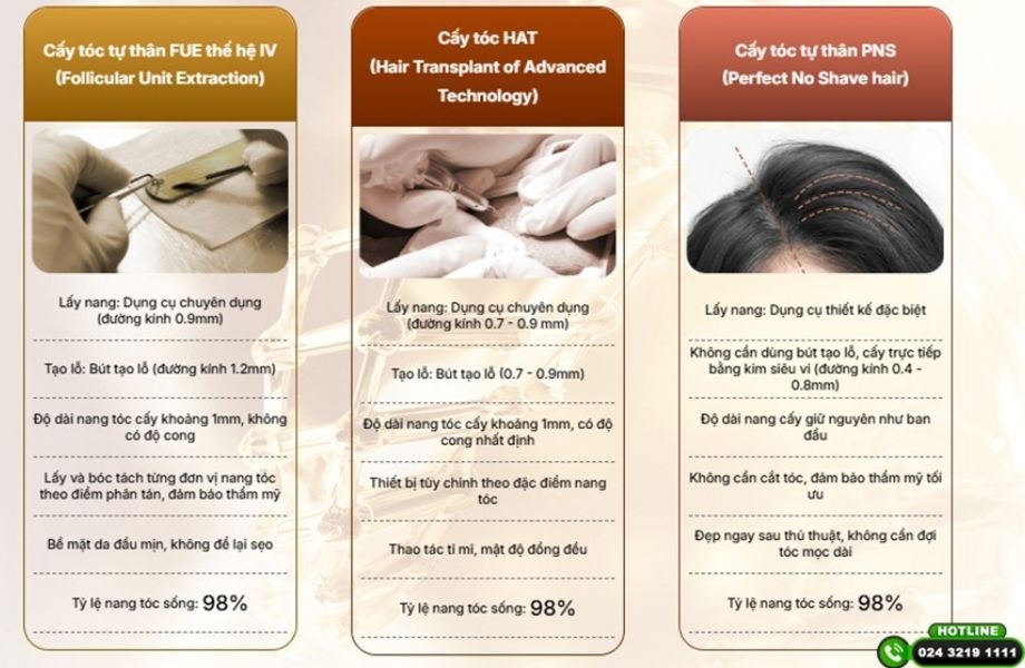 Cấy đường viền chân tóc bằng công nghệ PNS