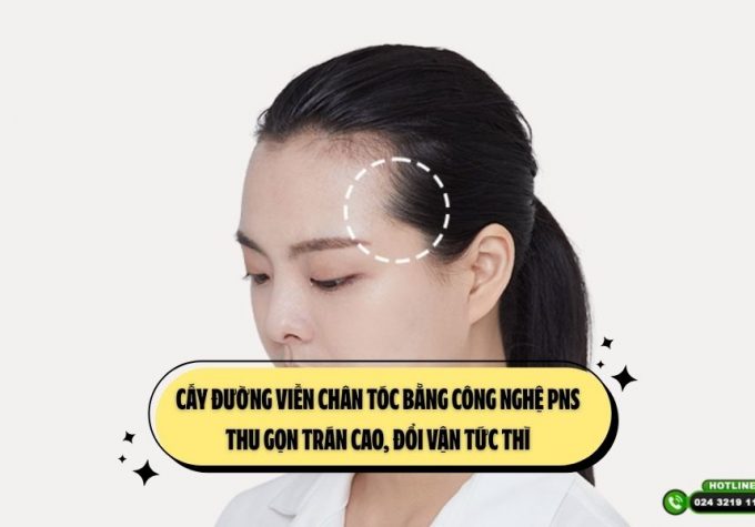 Cấy đường viền chân tóc bằng công nghệ PNS: Thu gọn trán cao, đổi vận tức thì