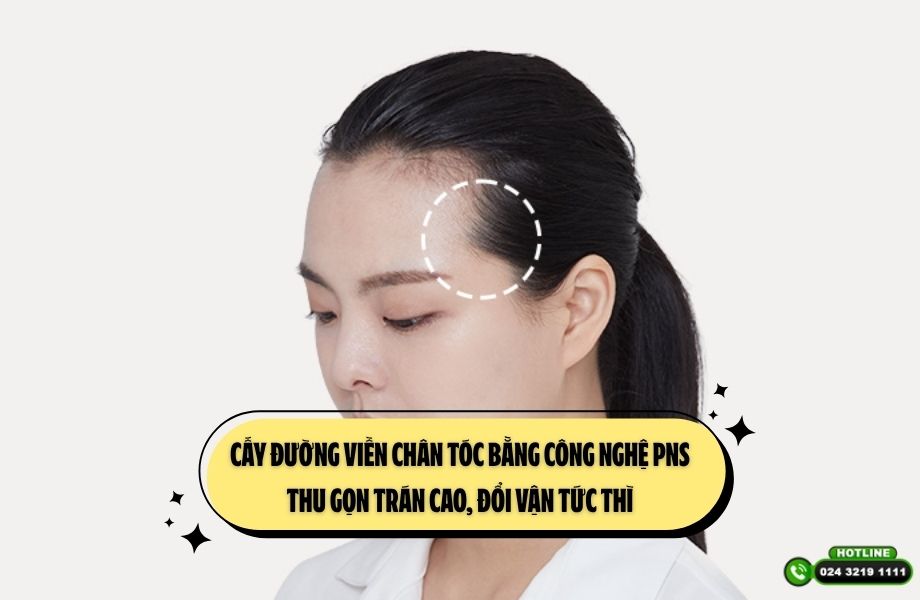 Cấy đường viền chân tóc bằng công nghệ PNS: Thu gọn trán cao, đổi vận tức thì