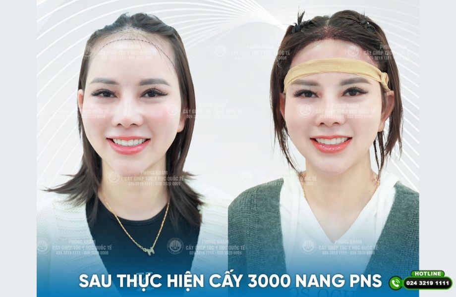 Cấy đường viền chân tóc bằng công nghệ PNS