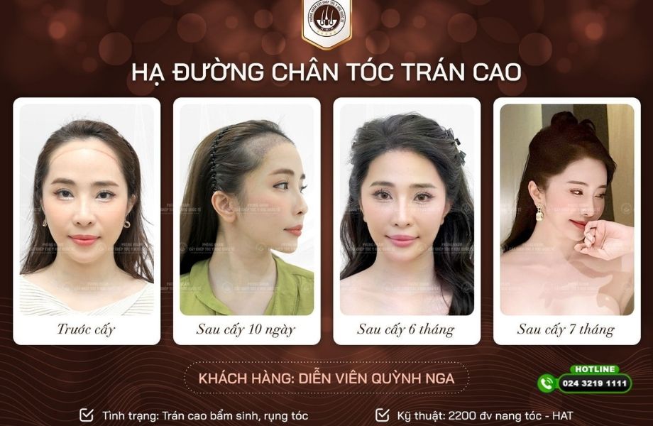 Cấy hạ đường chân tóc trán cao tại Phòng khám Cấy ghép tóc Y học quốc tế