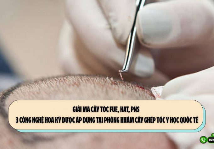 Giải mã cấy tóc FUE, HAT, PNS – 3 công nghệ Hoa Kỳ được áp dụng tại Phòng khám Cấy ghép tóc Y học Quốc tế