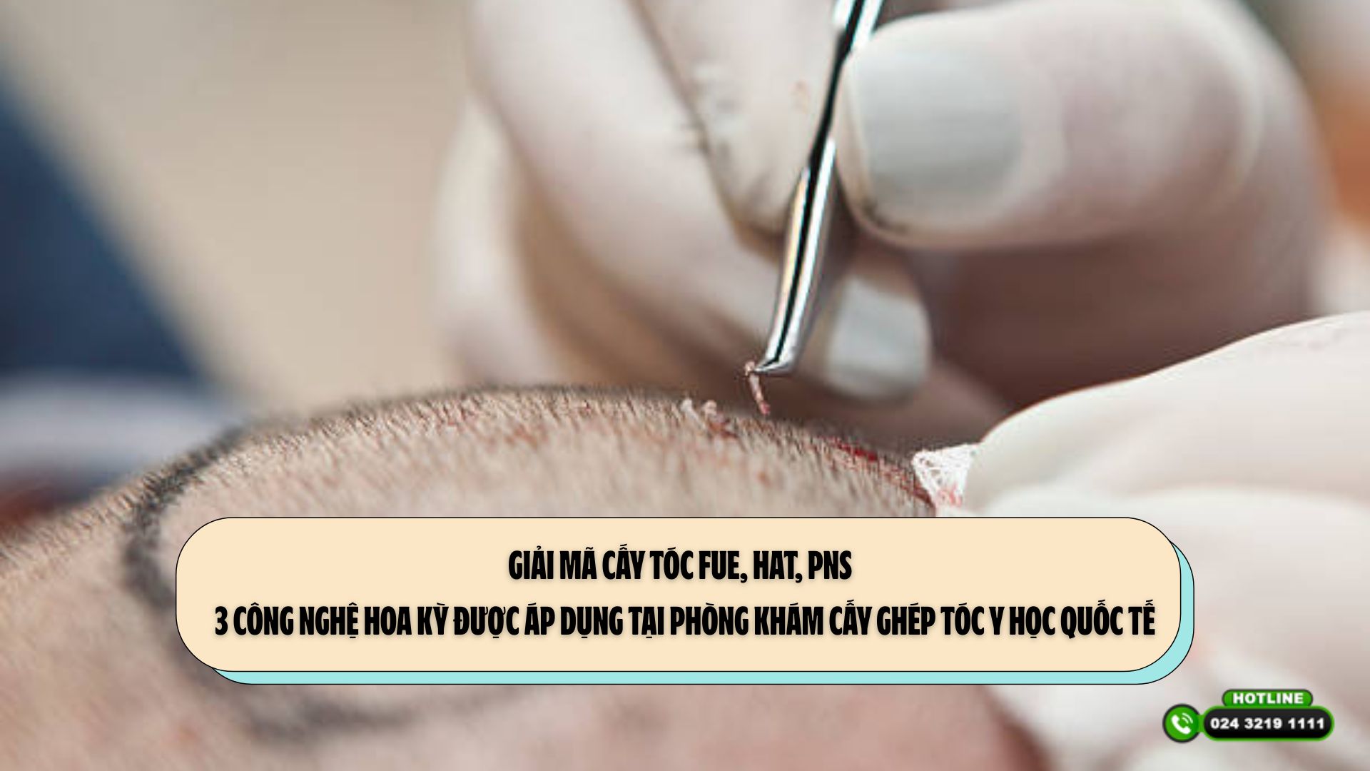 Giải mã cấy tóc FUE, HAT, PNS – 3 công nghệ Hoa Kỳ được áp dụng tại Phòng khám Cấy ghép tóc Y học Quốc tế