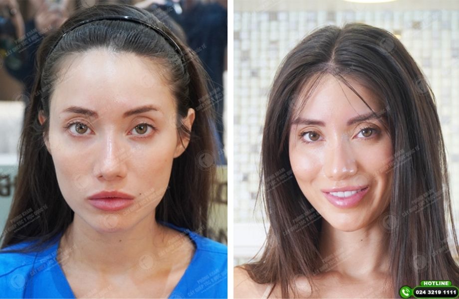 Cấy đường viền chân tóc bằng công nghệ PNS