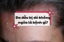 Da đầu bị đỏ không ngứa là bệnh gì? Có điều trị được không?