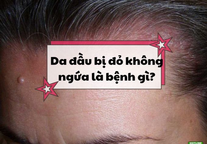 Da đầu bị đỏ không ngứa là bệnh gì? Có điều trị được không?