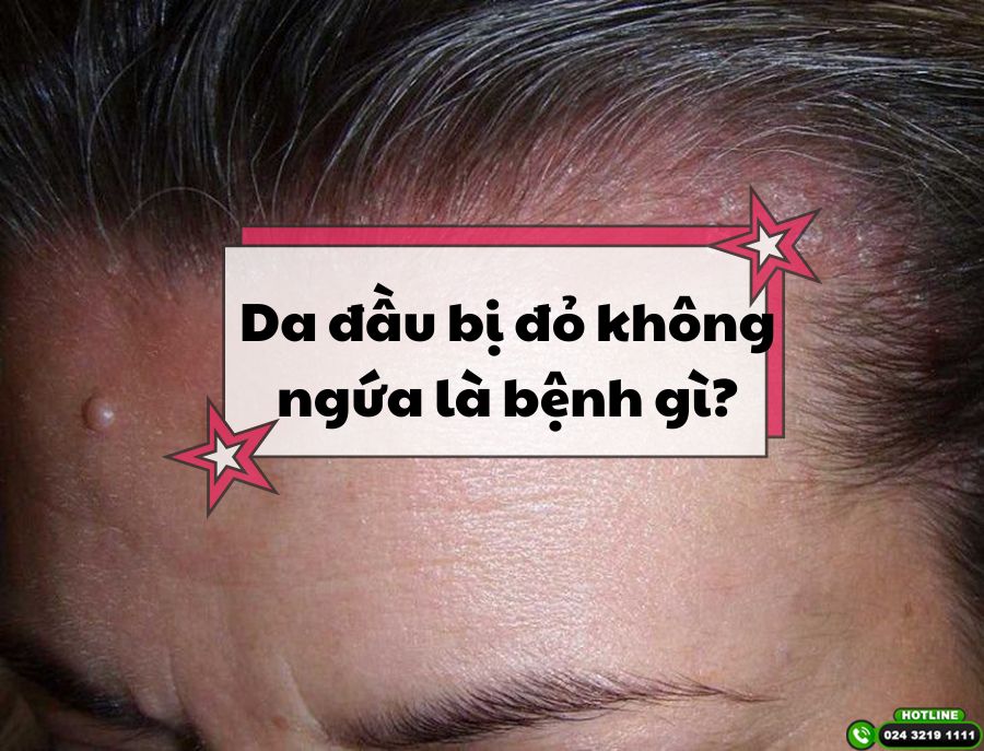 Da đầu bị đỏ không ngứa là bệnh gì? Có điều trị được không?