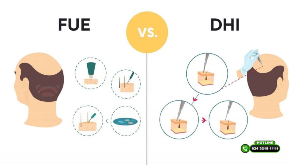 So sánh cấy tóc FUE và DHI