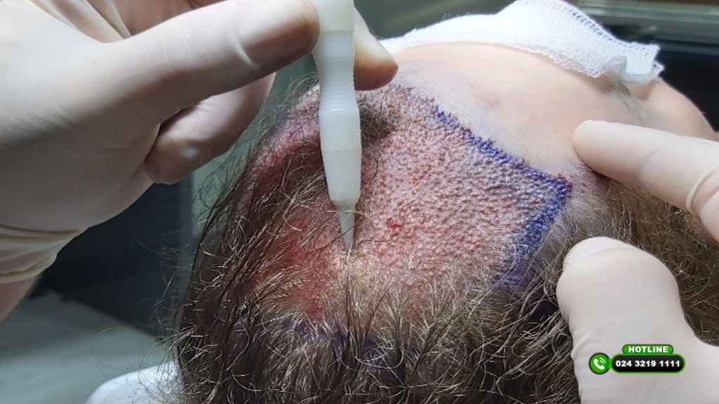 So sánh cấy tóc FUE và DHI