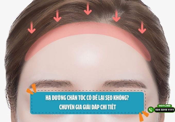 Hạ đường chân tóc có để lại sẹo không? Chuyên gia giải đáp chi tiết