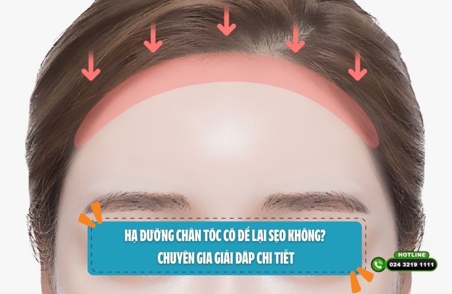 Hạ đường chân tóc có để lại sẹo không? Chuyên gia giải đáp chi tiết