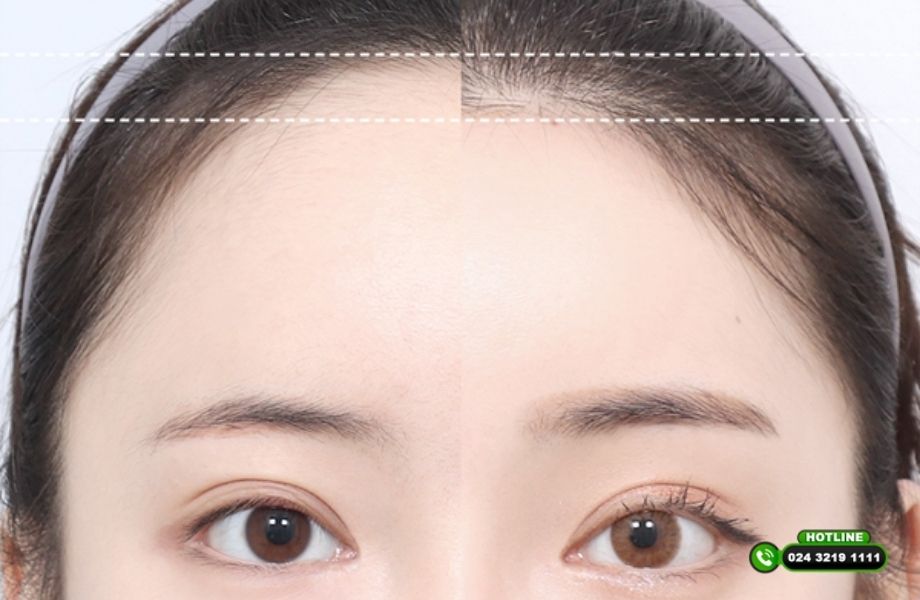 Hạ đường chân tóc có để lại sẹo không? 