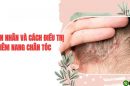 Nguyên nhân gây viêm nang chân tóc và cách điều trị hiệu quả