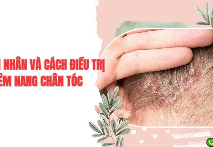 Nguyên nhân gây viêm nang chân tóc và cách điều trị hiệu quả
