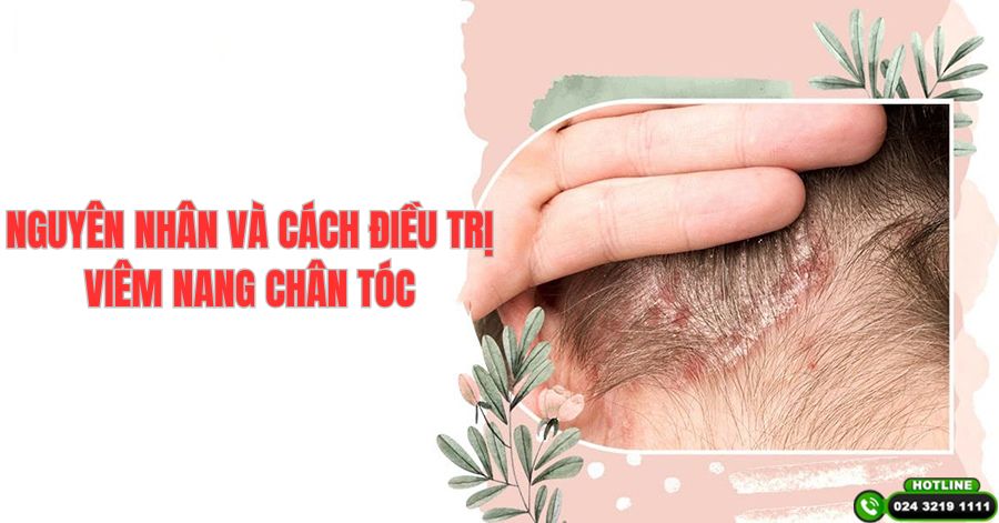 Nguyên nhân gây viêm nang chân tóc và cách điều trị hiệu quả