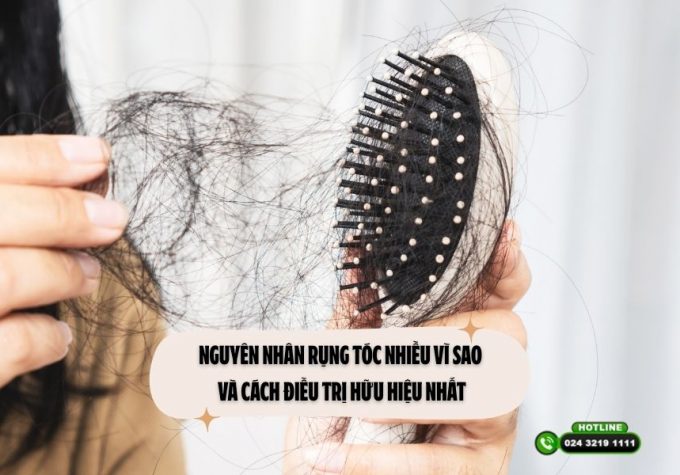 Nguyên nhân rụng tóc nhiều vì sao và cách điều trị hữu hiệu nhất