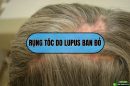 Rụng tóc do lupus ban đỏ và cách điều trị