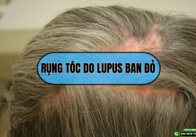 Rụng tóc do lupus ban đỏ và cách điều trị