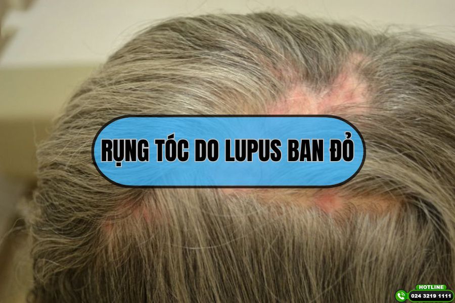 Rụng tóc do lupus ban đỏ và cách điều trị