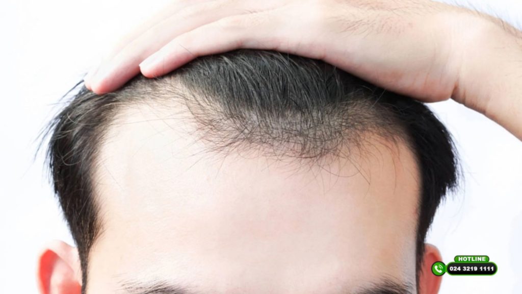 Cấy tóc FUE, HAT, PNS tại Phòng khám Cấy ghép tóc Y học Quốc tế