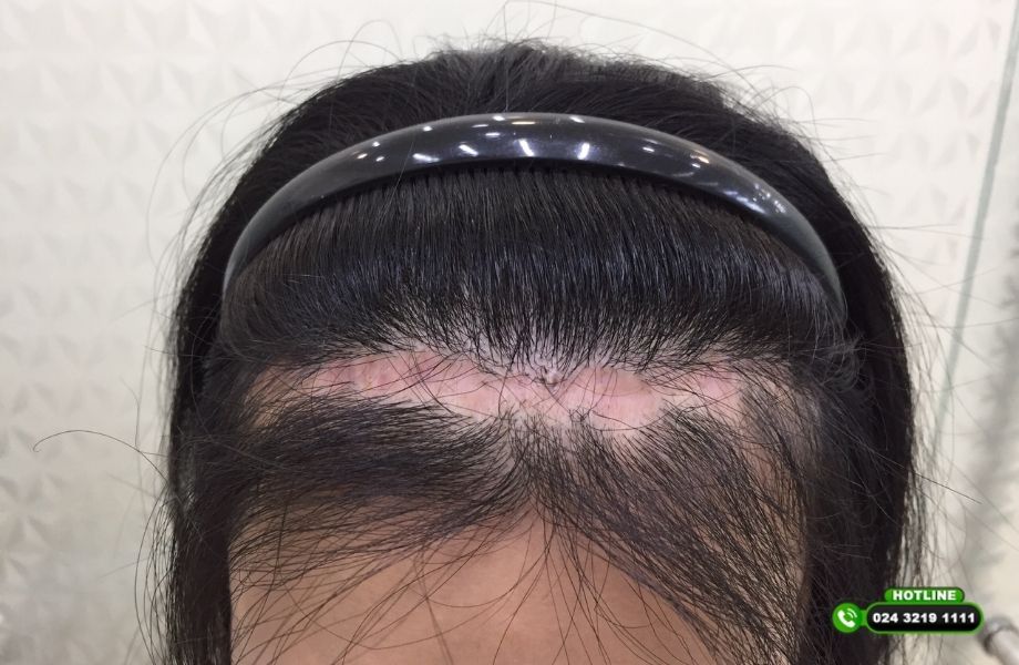 Hạ đường chân tóc có để lại sẹo không?