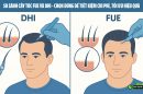 So sánh cấy tóc FUE và DHI – Chọn đúng để tiết kiệm chi phí, tối ưu hiệu quả