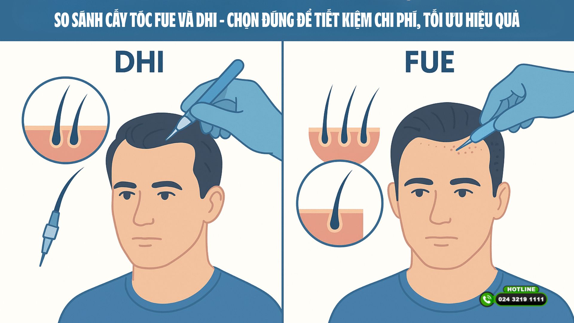 So sánh cấy tóc FUE và DHI – Chọn đúng để tiết kiệm chi phí, tối ưu hiệu quả