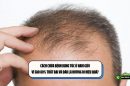 Cách chữa bệnh rụng tóc ở nam giới: Vì sao 80% thất bại và đâu là hướng đi hiệu quả?