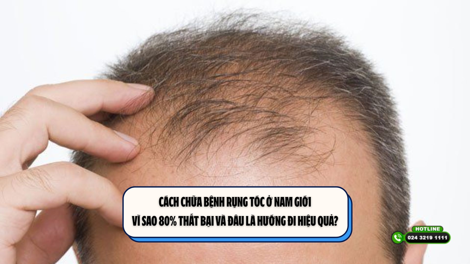 Cách chữa bệnh rụng tóc ở nam giới: Vì sao 80% thất bại và đâu là hướng đi hiệu quả?