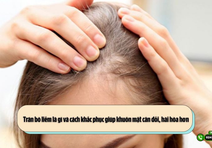 Trán bò liếm là gì và cách khắc phục giúp khuôn mặt cân đối, hài hòa hơn