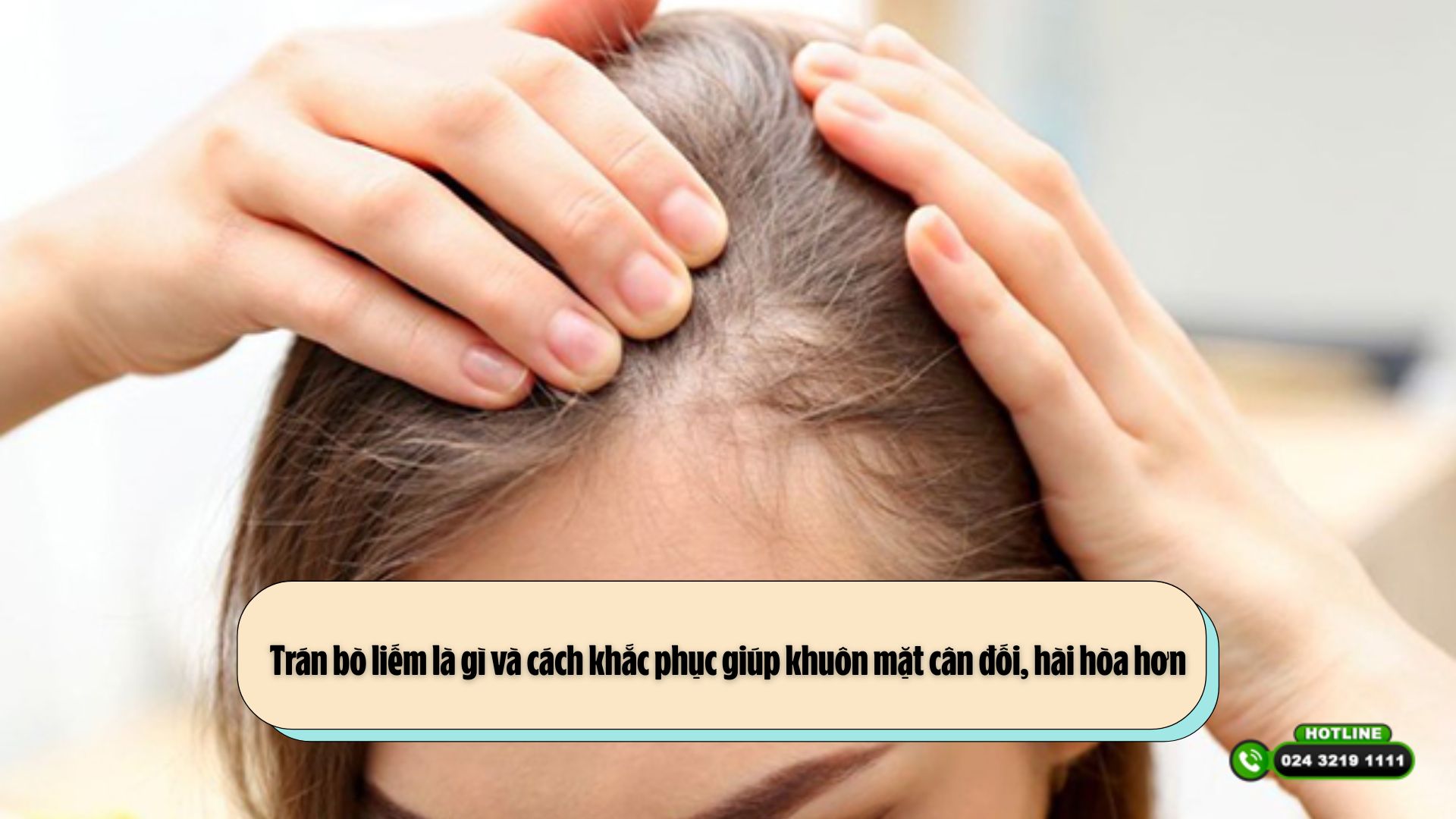 Trán bò liếm là gì và cách khắc phục giúp khuôn mặt cân đối, hài hòa hơn