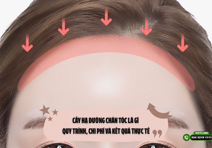 Cấy hạ đường chân tóc là gì – Quy trình, chi phí và kết quả thực tế