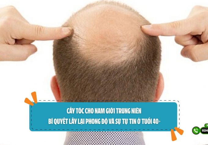Cấy tóc cho nam giới trung niên: Bí quyết lấy lại phong độ và sự tự tin ở tuổi 40+