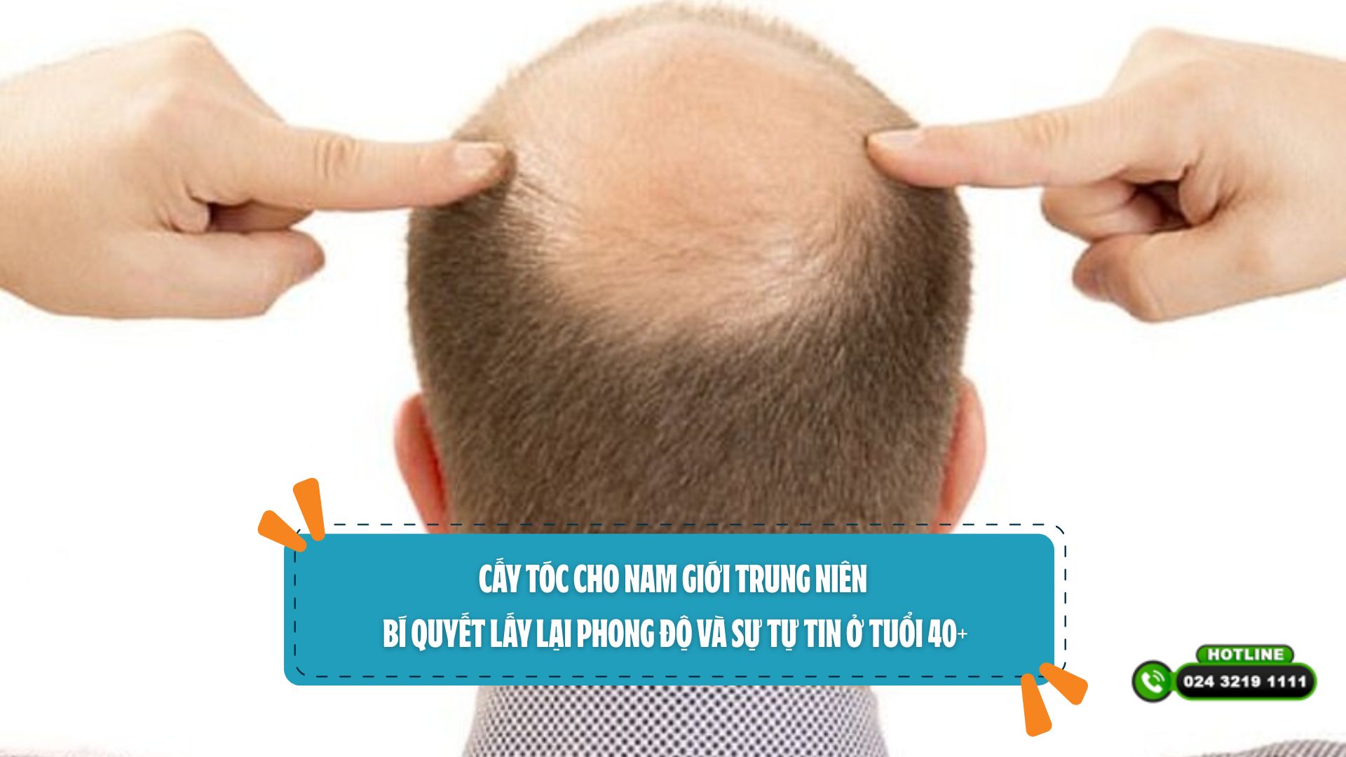 Cấy tóc cho nam giới trung niên: Bí quyết lấy lại phong độ và sự tự tin ở tuổi 40+