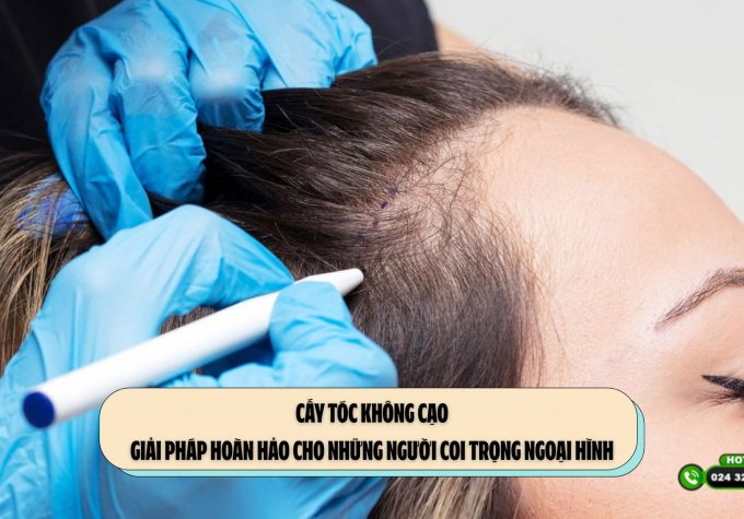 Cấy tóc không cạo: Giải pháp hoàn hảo cho những người coi trọng ngoại hình