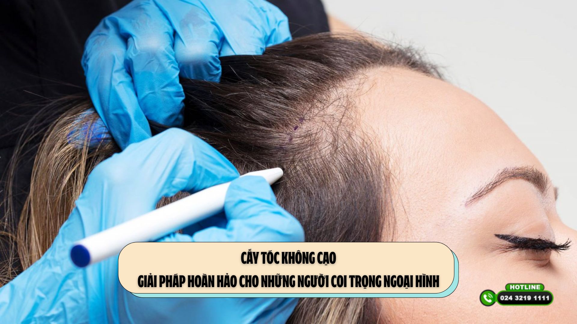 Cấy tóc không cạo: Giải pháp hoàn hảo cho những người coi trọng ngoại hình