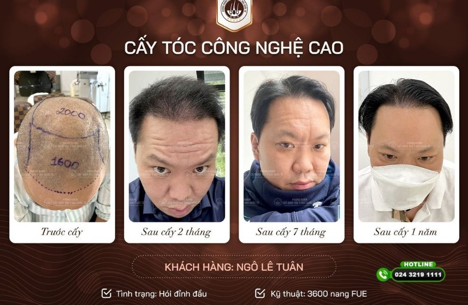 Hiểu rõ cấy tóc DHI và FUE phương pháp nào tốt hơn trước khi xuống tiền làm đẹp