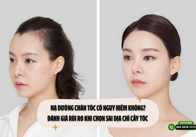 Hạ đường chân tóc có nguy hiểm không? Đánh giá rủi ro khi chọn sai địa chỉ cấy tóc