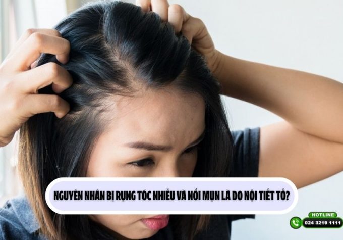 Nguyên nhân bị rụng tóc nhiều và nổi mụn là do nội tiết tố?