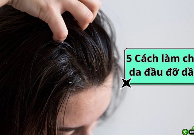 Giải cứu mái tóc bết nhờn với 5 cách làm cho da đầu đỡ dầu cực hiệu quả