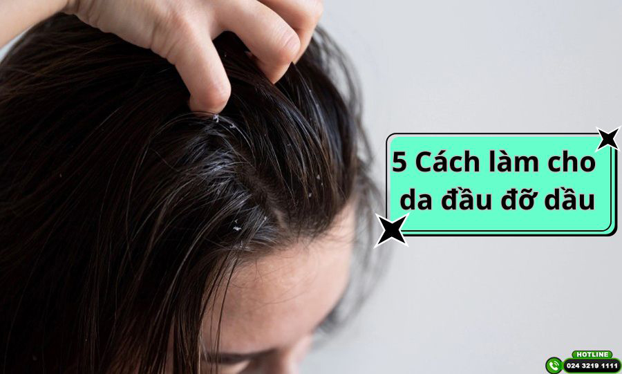 Giải cứu mái tóc bết nhờn với 5 cách làm cho da đầu đỡ dầu cực hiệu quả